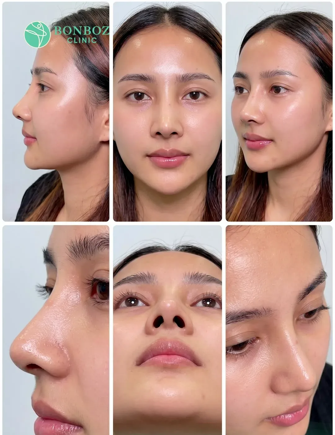Nâng mũi — ảnh trước và sau của khách