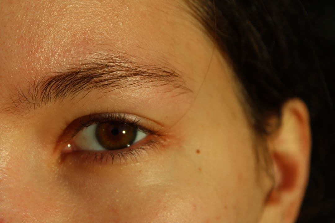 ¿Qué es la blefaroplastia con cantoplastia? Diferencias con la blefaroplastia convencional