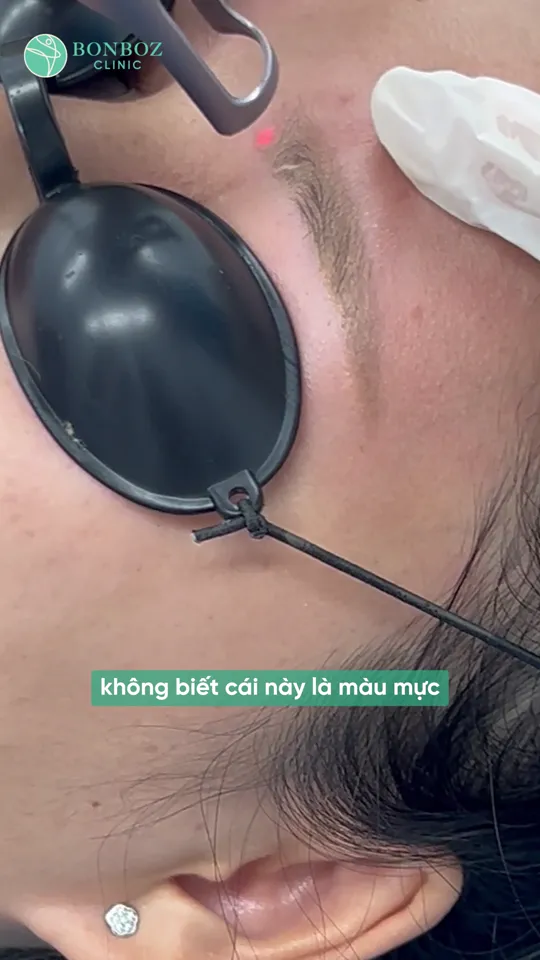 Sau xoá xăm chân mày: hồi phục ngày 1, 3, 7 của một ca thật và cách chăm sóc