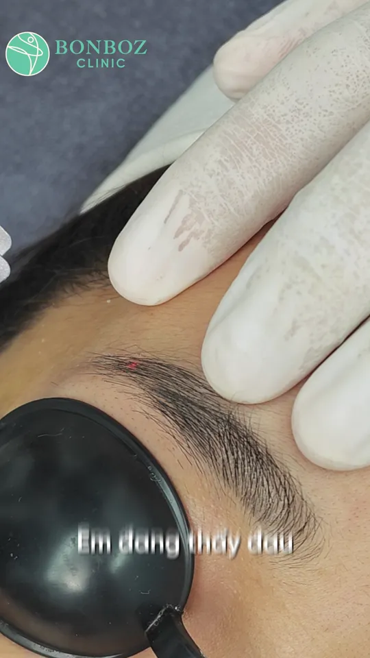 Xoá xăm chân mày bằng laser có đau không, có để lại sẹo không?