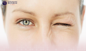 Phương pháp điều trị co thắt cơ mí mắt