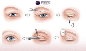 Phẫu thuật cắt da thừa mí mắt: Những lưu ý cần biết