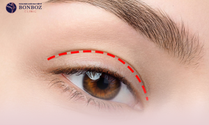 Phẫu thuật cắt mí mắt có ảnh hưởng đến thị lực không?