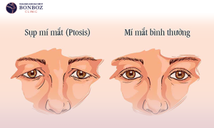Phân loại các tình trạng sụp mí mắt và cách khắc phục hiệu quả