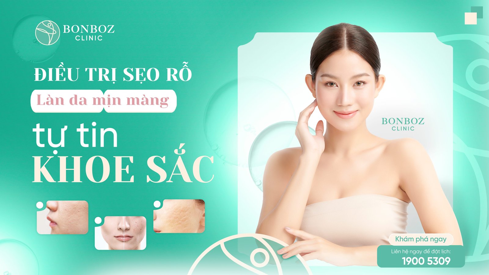 Điều trị sẹo rỗ: Làn da mịn màng, tự tin khoe sắc