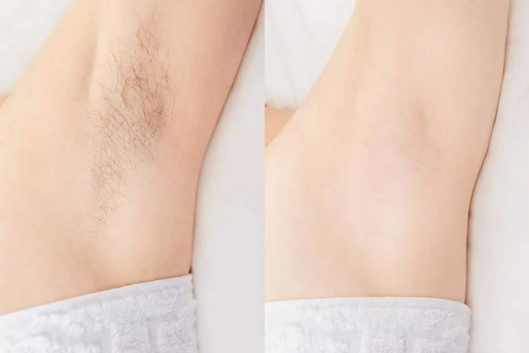 Giải đáp chi tiết: Wax lông nách có bị thâm không và cách wax an toàn 4 Wax lông nách an toàn giúp vùng nách mịn màng, không thâm.
